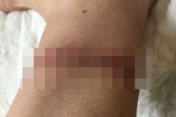 Woman suffers gruesome ‘garrotte’ injury as she issues warning over dangerous dog leads