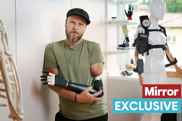‘My arm was chopped off at work – now I’ve got world’s first bionic arm’