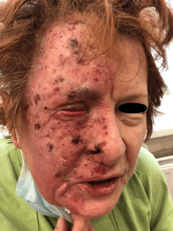 The horrifying condition that leaves sufferers ‘ripping their own skin off’