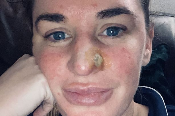 Nurse addicted to sunbeds left with 5p-sized hole in nose after pimple turned out to be cancer