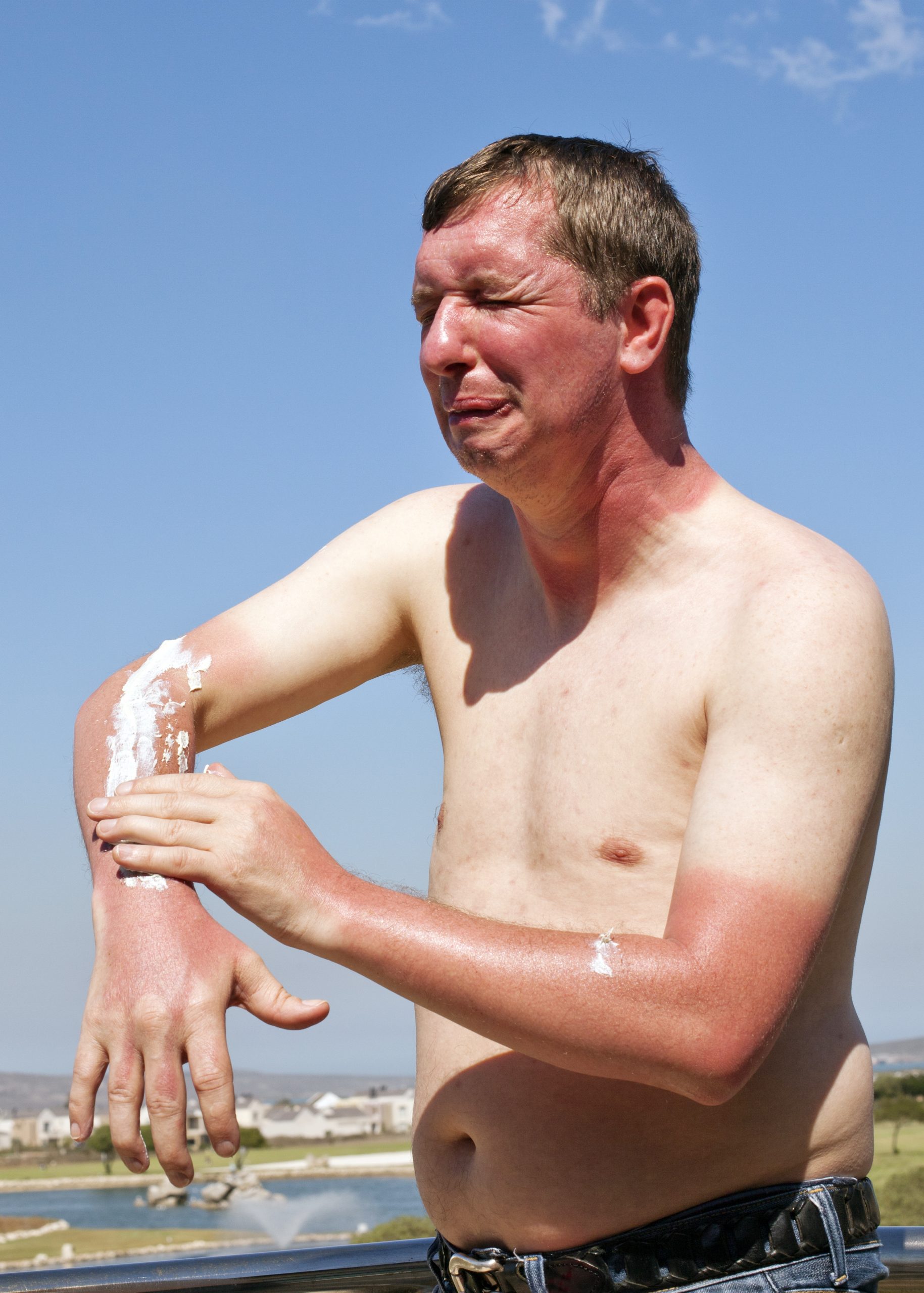 My ‘unorthodox’ trick will drastically reduce your discomfort when you get a sunburn – sounds weird but it works