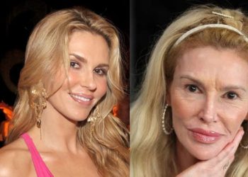 Brandi Glanville ‘scared to death’ ahead of new corrective surgery on her face